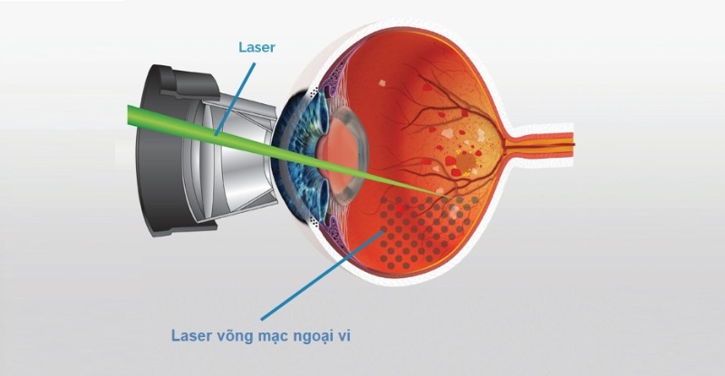 Phương pháp laser quang đông